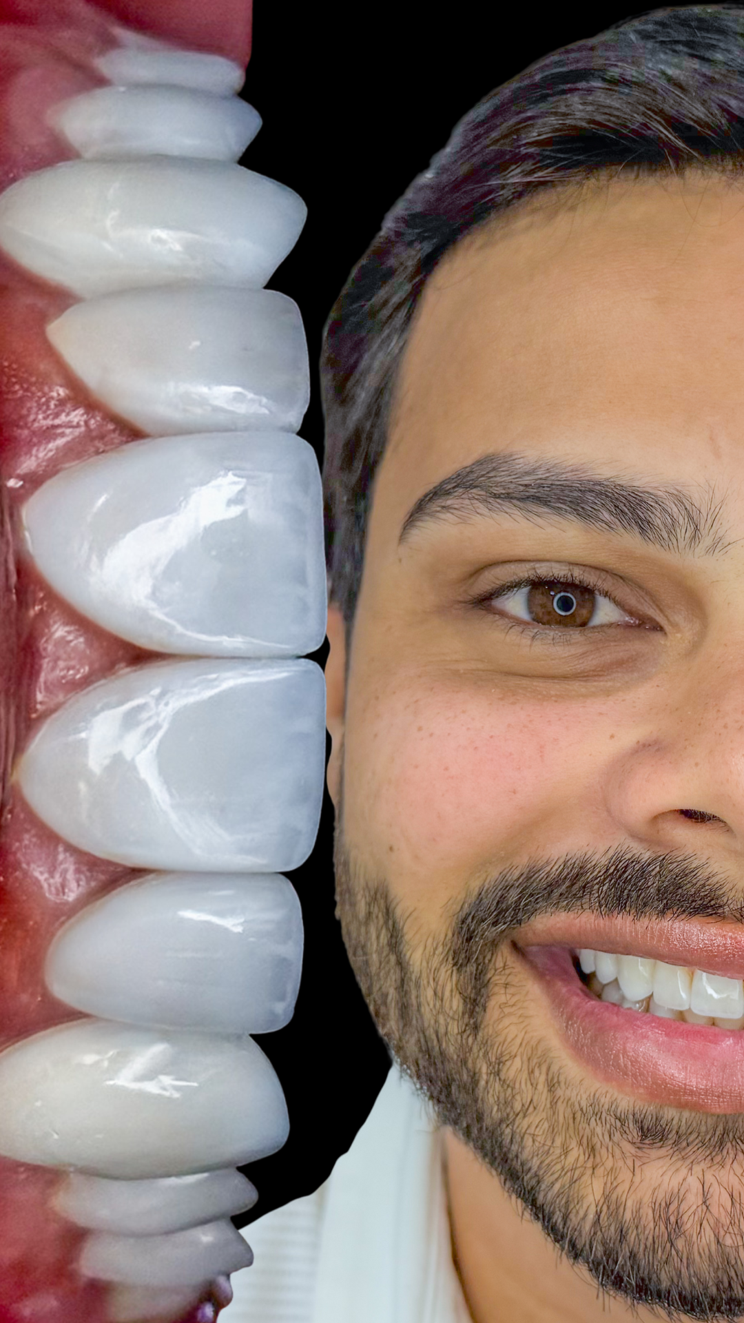 Facetas em Resina (Capa para Reels do Instagram)